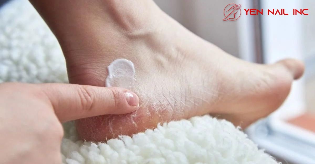 Why Do Our Feet Get Dry/Cracked?